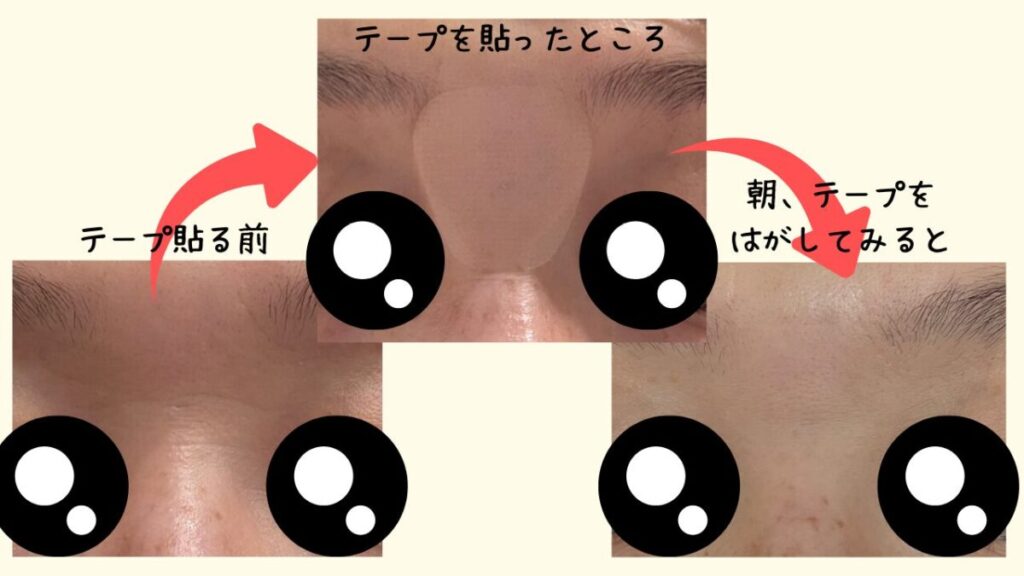 マジラボしわ伸ばしテープビフォーアフター